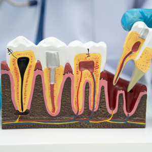 RE-ROOT CANAL TREATMENT